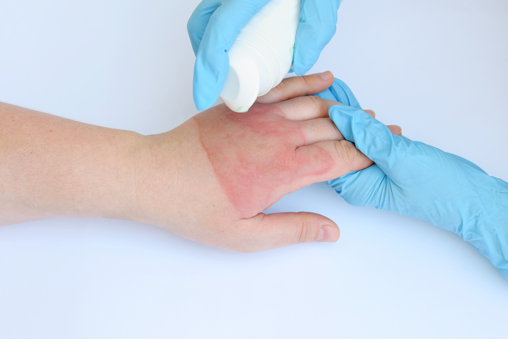 tips on how to get rid of heating pad burns