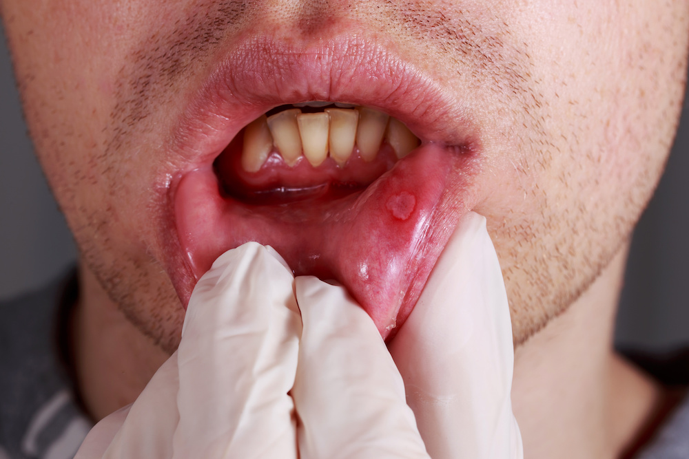 learn if can vaping cause canker sores