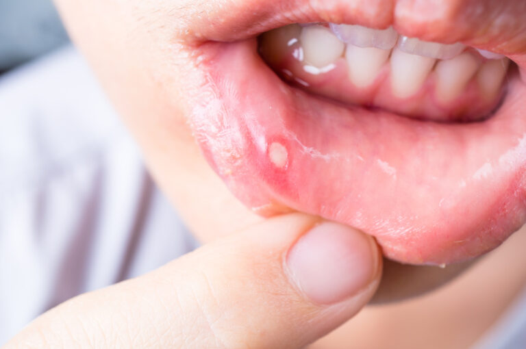 does lysine help canker sores